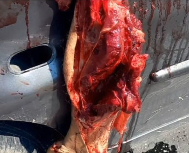 A severed leg hung on the car door