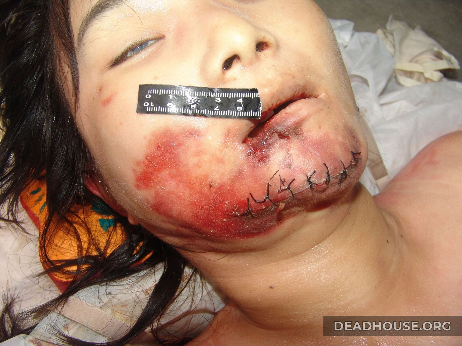 Bruises and trauma to the chin on the face of a dead girl
