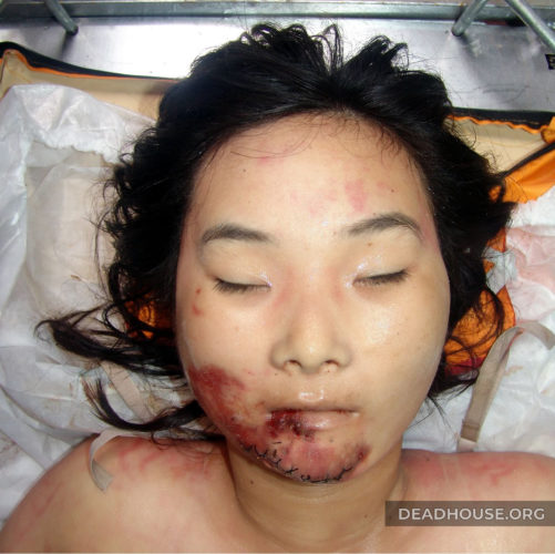 Dead chinese girl with bruises on her face