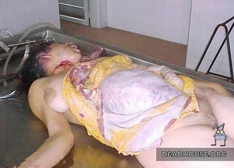 Autopsy of a pregnant woman