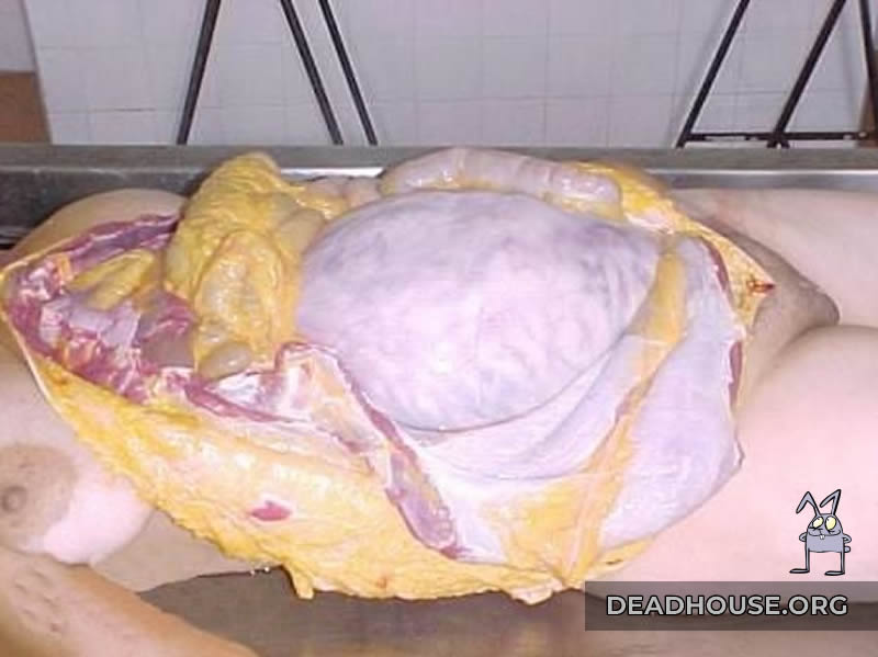 Autopsy of a pregnant woman in a morgue