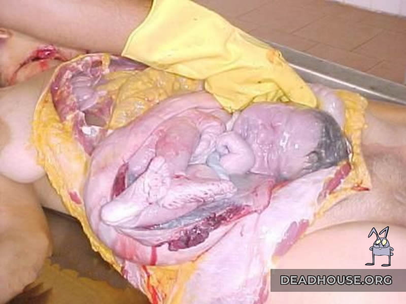 Uterus incision. Stillbirth