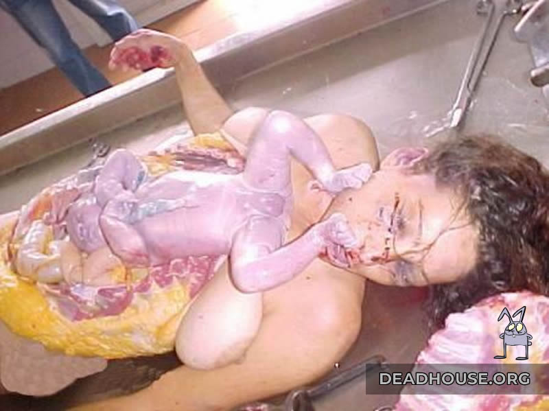 Autopsy of a pregnant woman at a late stage of pregnancy