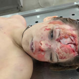 Corpse of a girl in the morgue. Road accident result