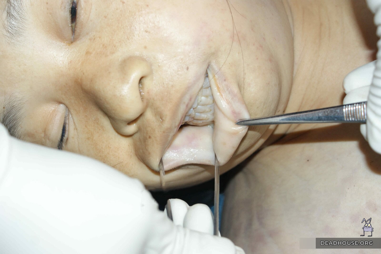 External examination of the gums and lips