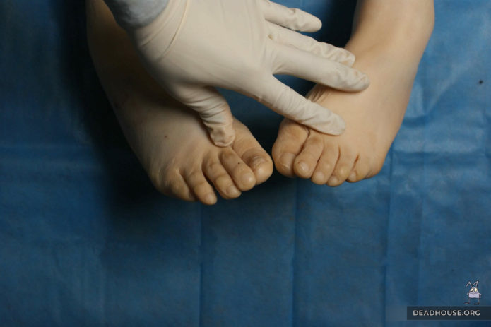 Feet of a woman's corpse. Inspection