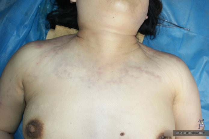 Chest and neck area. External examination of the corpse