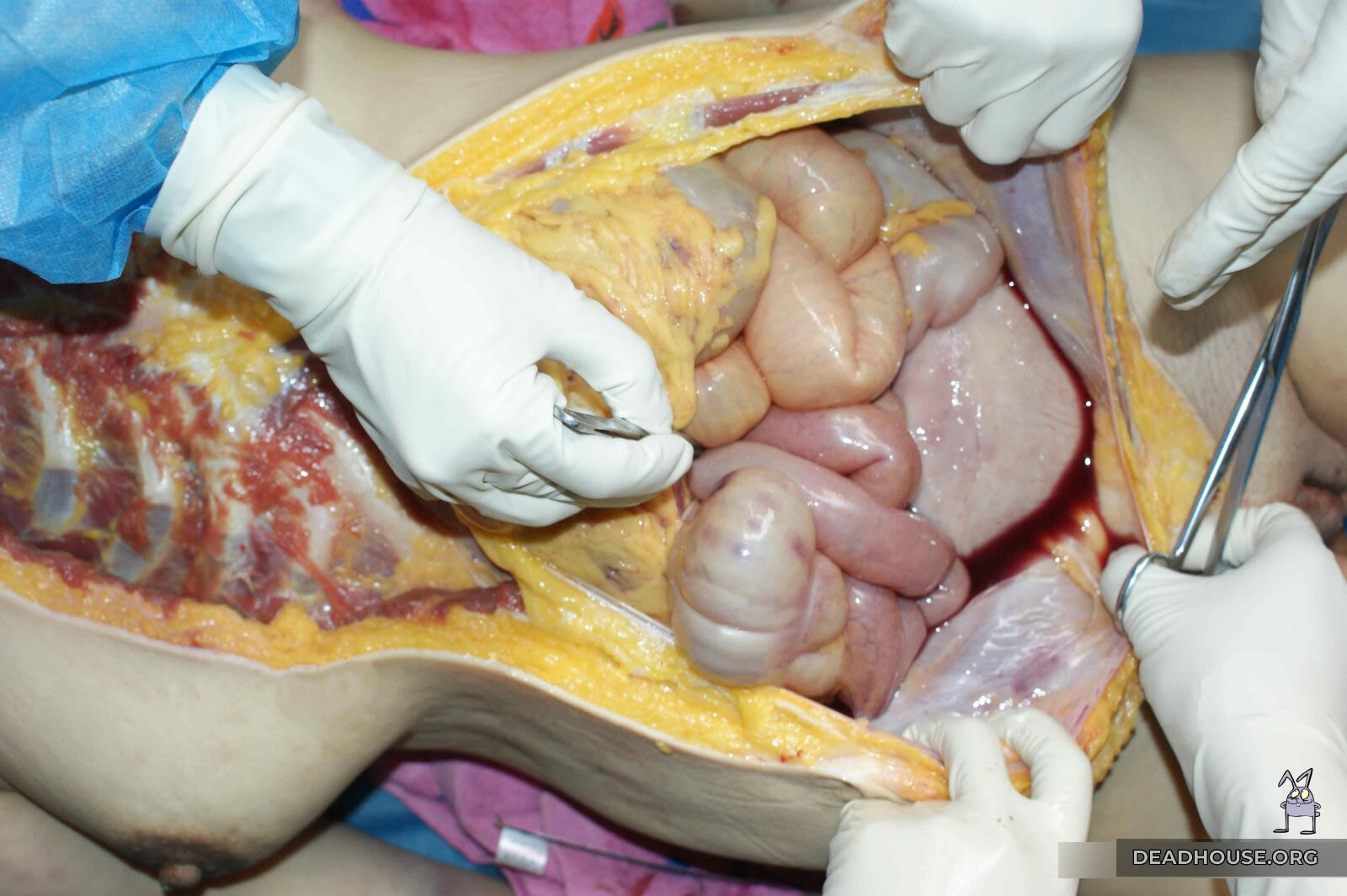 Hemorrhage into the anterior abdominal wall
