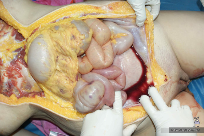 Hemorrhage into the anterior abdominal wall