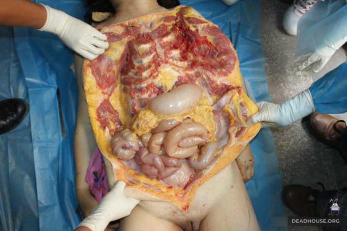 View of the abdominal cavity. Intestines