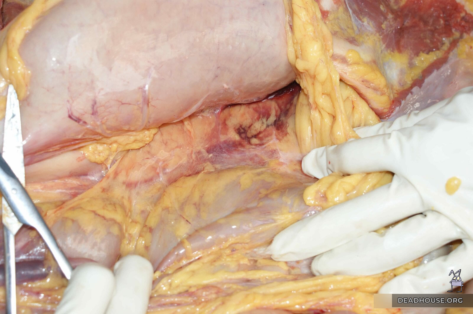 The inside of the abdominal cavity. Hemorrhage