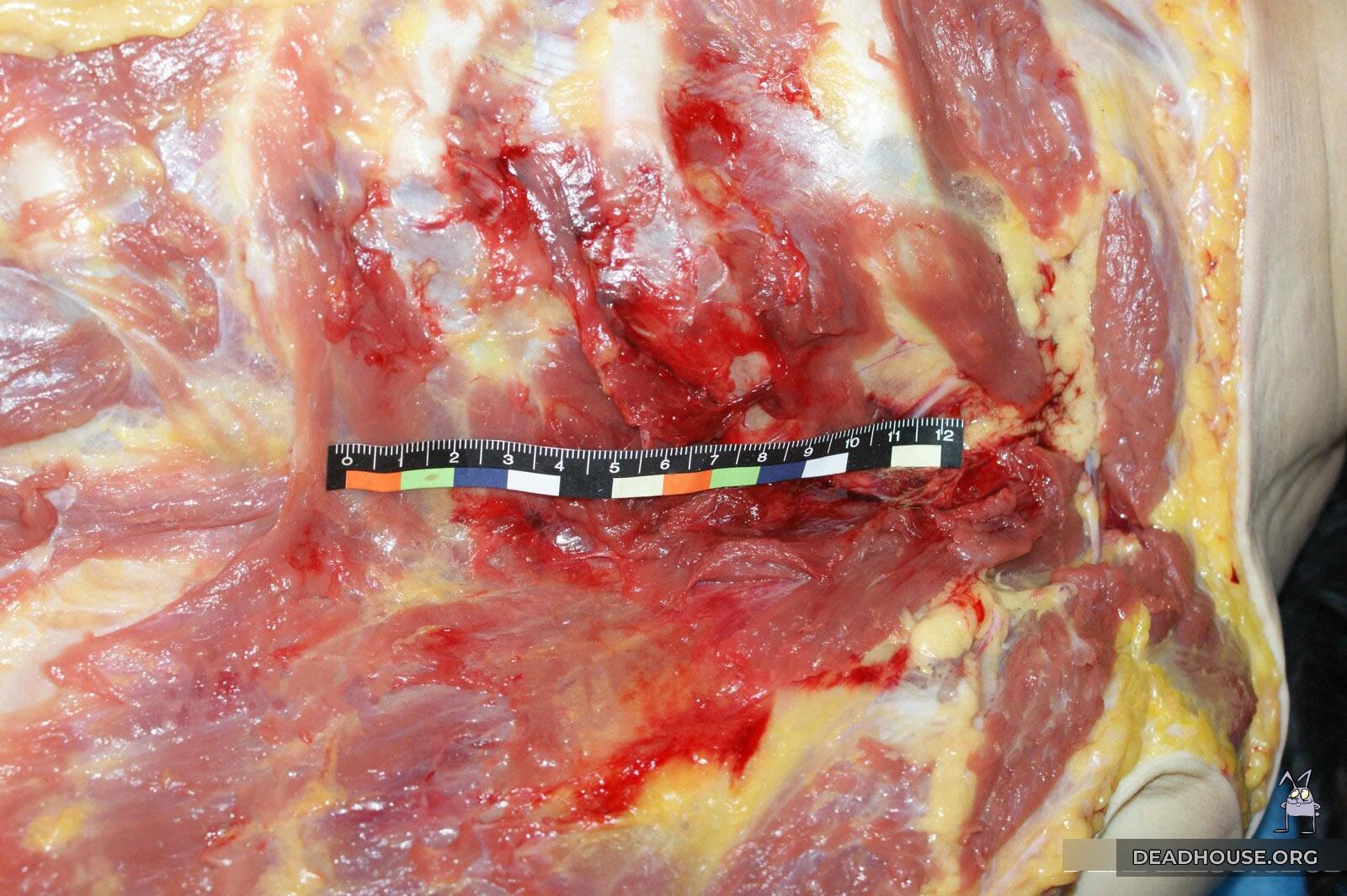 Hemorrhage in the chest area. Measurements