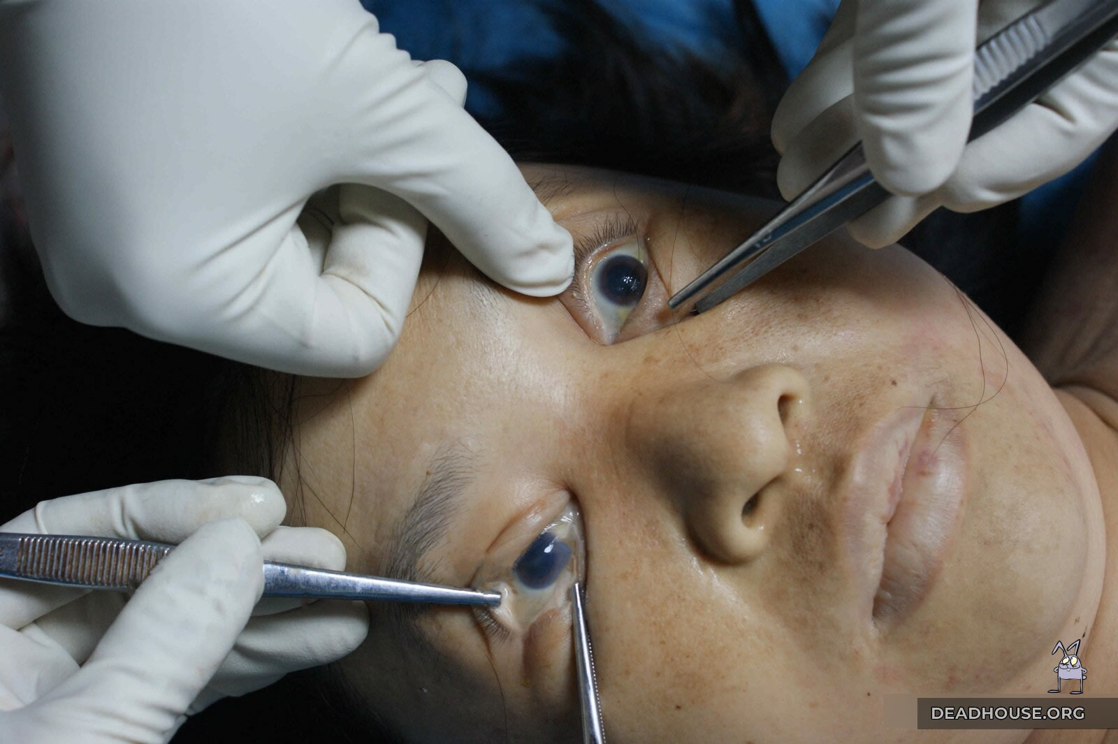 Corpse Eye Examination