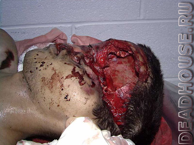 Corpse in the morgue. Victim of a car accident