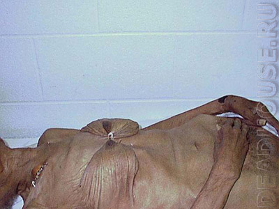 Corpse of a woman with bandaged breasts