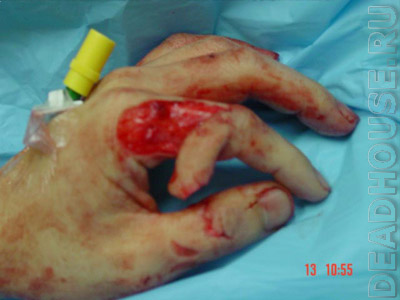 Traumatic amputation of a finger