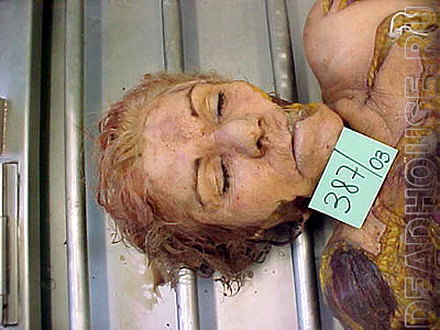 Partially decomposed corpse of a woman in a morgue