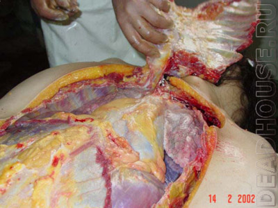 Autopsy of the corpse of a young woman in the morgue