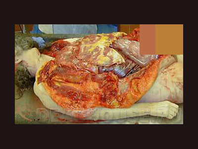 The corpse of a woman. Autopsy in the morgue