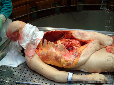 Autopsy of a female corpse