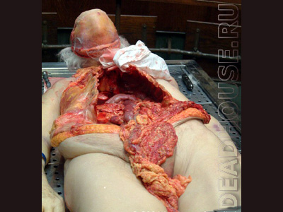 Autopsy of a female corpse