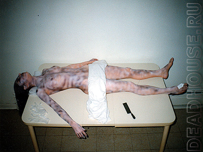 The corpse of a raped woman in a morgue