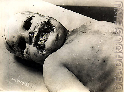 Corpse of a boy in a morgue