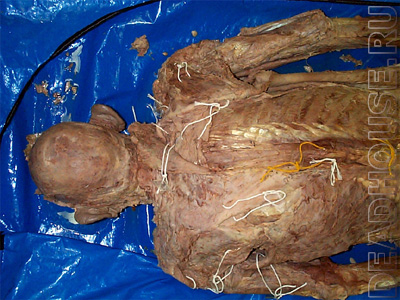 Mummified corpse of a man in a morgue