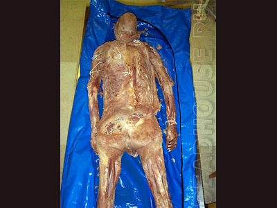 Mummified corpse of a man in a morgue