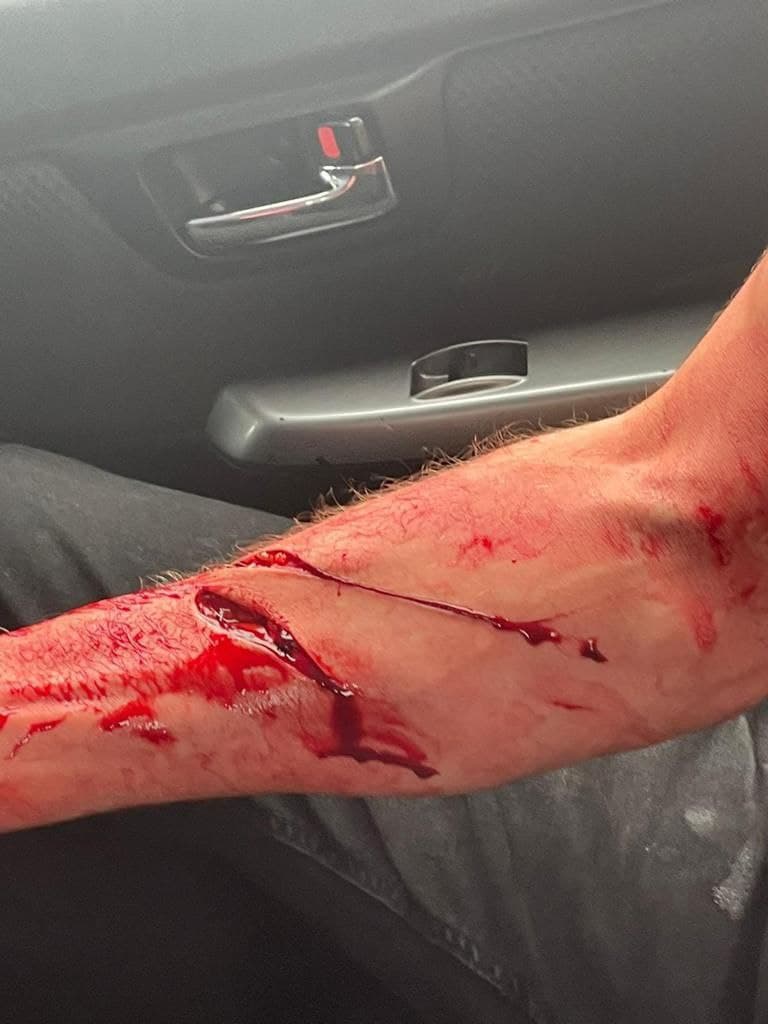 Machete wound on hand