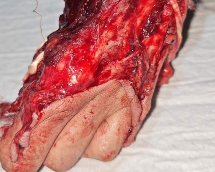 Partial amputation of fingers and hand