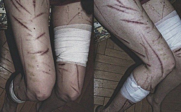 Girl's legs with deep scars