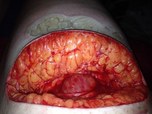 Thigh incision