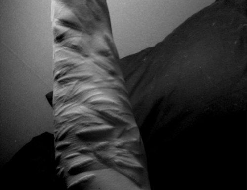 Hand scars