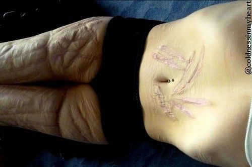 Scarred legs and abdomen
