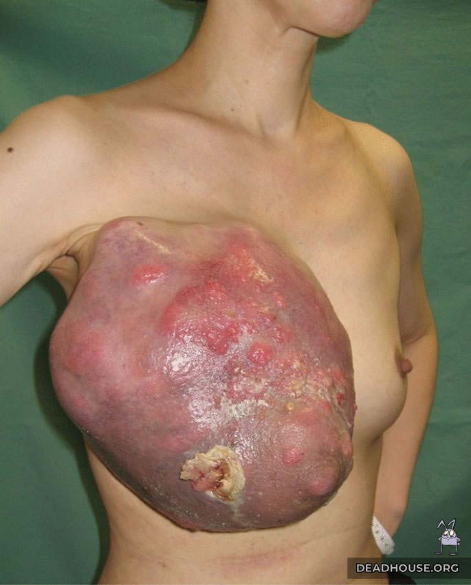 terminal stage  breast cancer