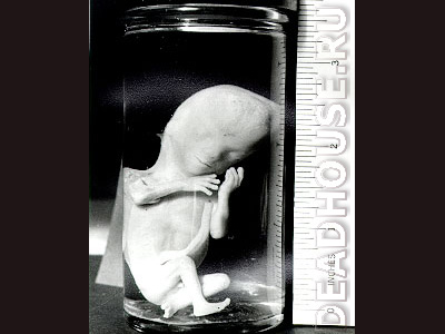 Human embryos. Results of abortions
