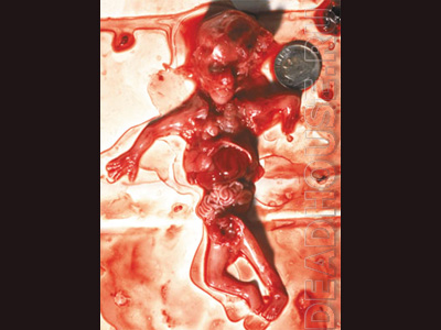 Human embryos. Results of abortions