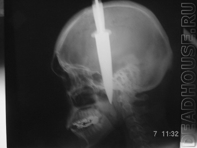 Traumatic brain injury. Knife in the head