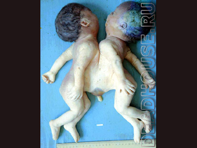 Malformations and mutations of newborns