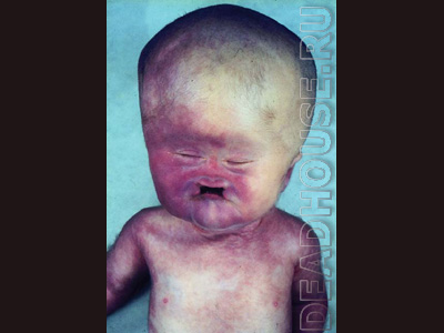 Malformations and mutations of newborns