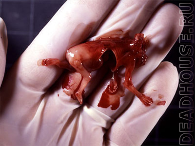 Abortion. Results of abortion