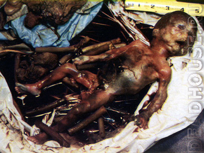 Abortion. Results of abortion