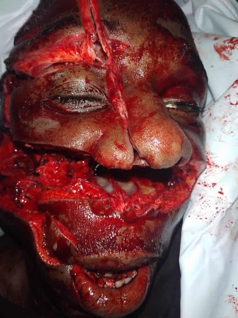 Face after being hit by a machete